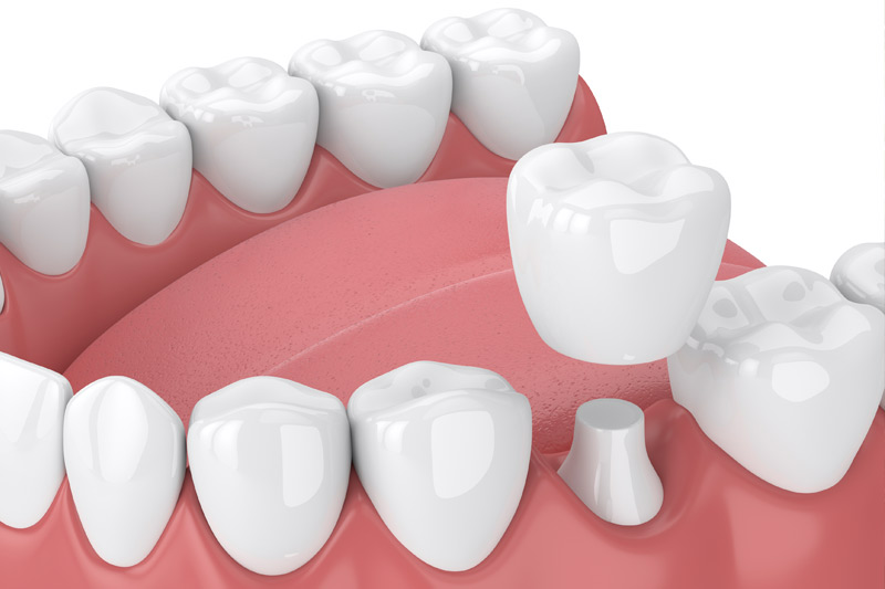 Dental Crowns in Hendersonville