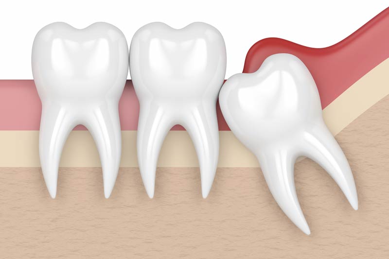 Wisdom Tooth Removal in Hendersonville